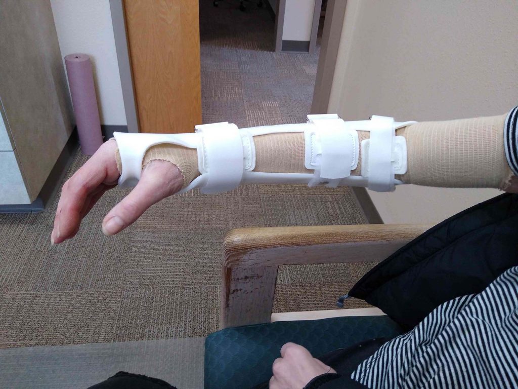 meunster style ulnar fracture orthosis
