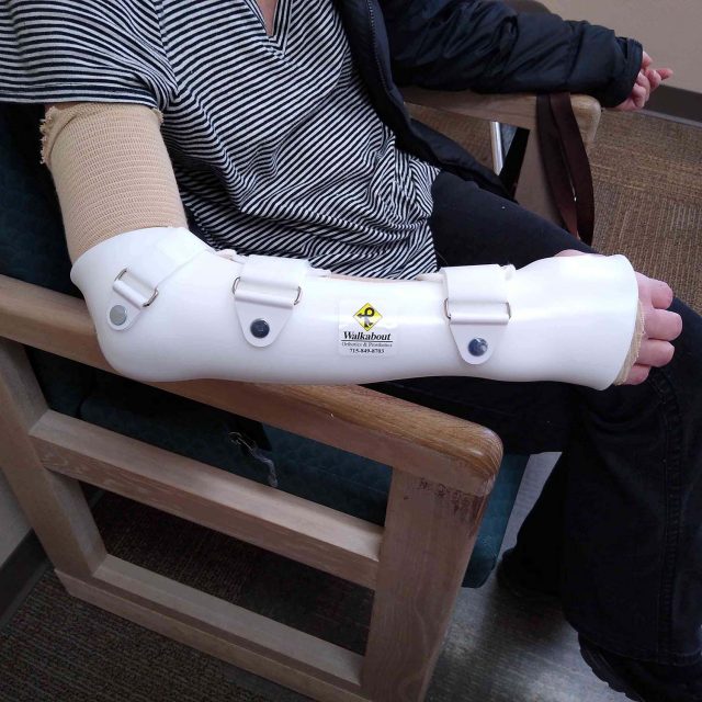 Meunster-Style Ulnar Fracture Orthosis
